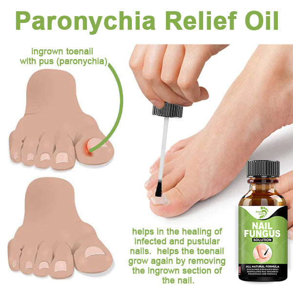 🔥FOOTCURE™ Removal Paronychia Gel (Fungal infections, ingrown nail, discolored or damaged nails