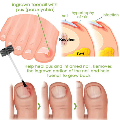 🔥FOOTCURE™ Removal Paronychia Gel (Fungal infections, ingrown nail, discolored or damaged nails